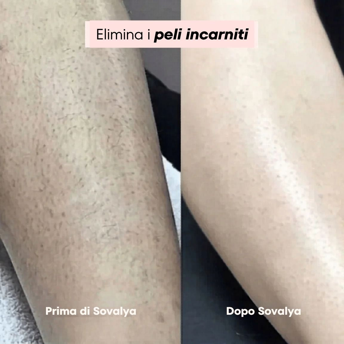 Sovalya - Rasatura intima senza irritazioni