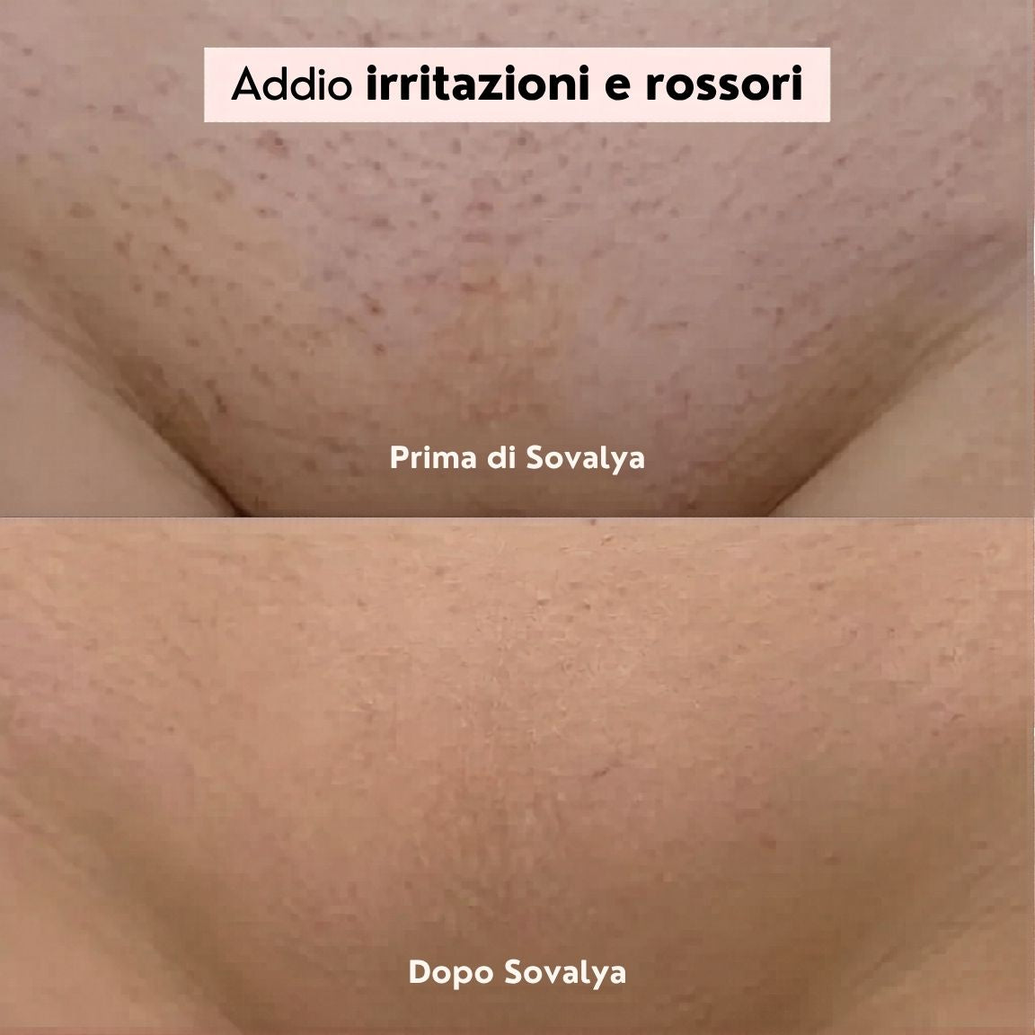 Sovalya - Rasatura intima senza irritazioni